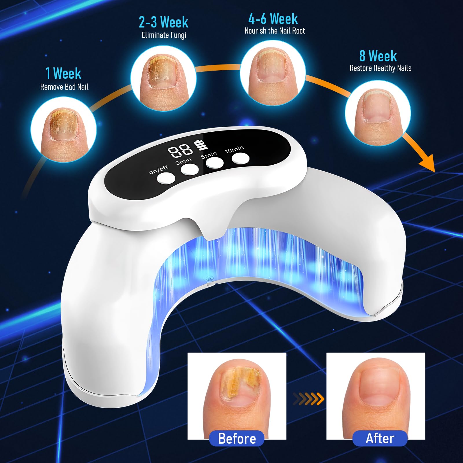 Fungal Nail Treatment Device 9 - Health & Wellness Utsg recension och pris